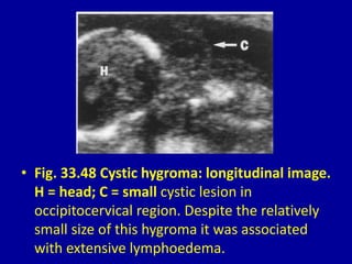 • Fig. 33.48 Cystic hygroma: longitudinal image.
H = head; C = small cystic lesion in
occipitocervical region. Despite the relatively
small size of this hygroma it was associated
with extensive lymphoedema.
 