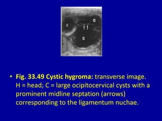• Fig. 33.49 Cystic hygroma: transverse image.
H = head; C = large ocipitocervical cysts with a
prominent midline septation (arrows)
corresponding to the ligamentum nuchae.
 