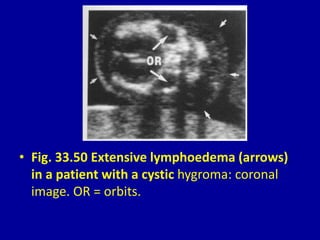 • Fig. 33.50 Extensive lymphoedema (arrows)
in a patient with a cystic hygroma: coronal
image. OR = orbits.
 