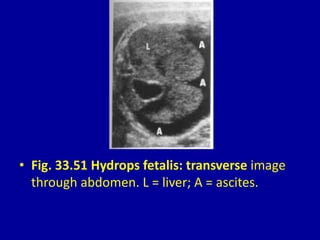 • Fig. 33.51 Hydrops fetalis: transverse image
through abdomen. L = liver; A = ascites.
 