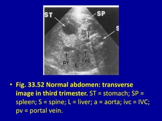 • Fig. 33.52 Normal abdomen: transverse
image in third trimester. ST = stomach; SP =
spleen; S = spine; L = liver; a = aorta; ivc = IVC;
pv = portal vein.
 