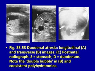 • Fig. 33.53 Duodenal atresia: longitudinal (A)
and transverse (B) images. (C) Postnatal
radiograph. S = stomach; D = duodenum.
Note the 'double bubble' in (B) and
coexistent polyhydramnios.
 