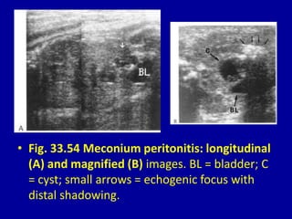 • Fig. 33.54 Meconium peritonitis: longitudinal
(A) and magnified (B) images. BL = bladder; C
= cyst; small arrows = echogenic focus with
distal shadowing.
 