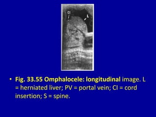 • Fig. 33.55 Omphalocele: longitudinal image. L
= herniated liver; PV = portal vein; CI = cord
insertion; S = spine.
 