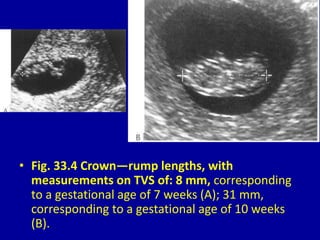 • Fig. 33.4 Crown—rump lengths, with
measurements on TVS of: 8 mm, corresponding
to a gestational age of 7 weeks (A); 31 mm,
corresponding to a gestational age of 10 weeks
(B).
 