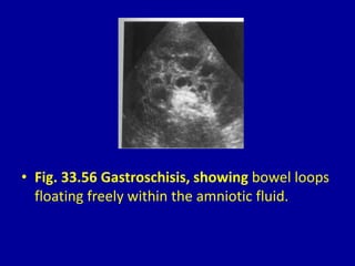 • Fig. 33.56 Gastroschisis, showing bowel loops
floating freely within the amniotic fluid.
 
