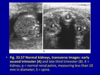 • Fig. 33.57 Normal kidneys, transverse images: early
second trimester (A) and late third trimester (B). K =
kidney; p = normal renal pelvis, measuring less than 10
mm in diameter; S = spine.
 