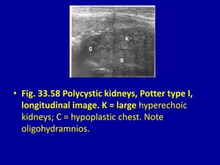 • Fig. 33.58 Polycystic kidneys, Potter type I,
longitudinal image. K = large hyperechoic
kidneys; C = hypoplastic chest. Note
oligohydramnios.
 