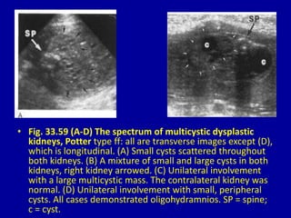 • Fig. 33.59 (A-D) The spectrum of multicystic dysplastic
kidneys, Potter type ff: all are transverse images except (D),
which is longitudinal. (A) Small cysts scattered throughout
both kidneys. (B) A mixture of small and large cysts in both
kidneys, right kidney arrowed. (C) Unilateral involvement
with a large multicystic mass. The contralateral kidney was
normal. (D) Unilateral involvement with small, peripheral
cysts. All cases demonstrated oligohydramnios. SP = spine;
c = cyst.
 