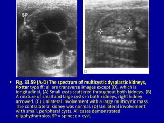• Fig. 33.59 (A-D) The spectrum of multicystic dysplastic kidneys,
Potter type ff: all are transverse images except (D), which is
longitudinal. (A) Small cysts scattered throughout both kidneys. (B)
A mixture of small and large cysts in both kidneys, right kidney
arrowed. (C) Unilateral involvement with a large multicystic mass.
The contralateral kidney was normal. (D) Unilateral involvement
with small, peripheral cysts. All cases demonstrated
oligohydramnios. SP = spine; c = cyst.
 