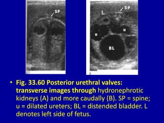 • Fig. 33.60 Posterior urethral valves:
transverse images through hydronephrotic
kidneys (A) and more caudally (B). SP = spine;
u = dilated ureters; BL = distended bladder. L
denotes left side of fetus.
 