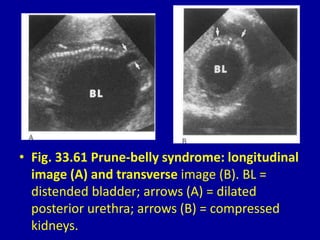 • Fig. 33.61 Prune-belly syndrome: longitudinal
image (A) and transverse image (B). BL =
distended bladder; arrows (A) = dilated
posterior urethra; arrows (B) = compressed
kidneys.
 