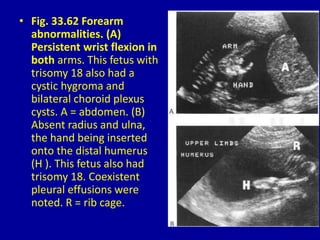 • Fig. 33.62 Forearm
abnormalities. (A)
Persistent wrist flexion in
both arms. This fetus with
trisomy 18 also had a
cystic hygroma and
bilateral choroid plexus
cysts. A = abdomen. (B)
Absent radius and ulna,
the hand being inserted
onto the distal humerus
(H ). This fetus also had
trisomy 18. Coexistent
pleural effusions were
noted. R = rib cage.
 