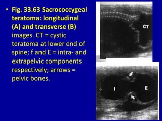 • Fig. 33.63 Sacrococcygeal
teratoma: longitudinal
(A) and transverse (B)
images. CT = cystic
teratoma at lower end of
spine; f and E = intra- and
extrapelvic components
respectively; arrows =
pelvic bones.
 