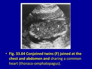 • Fig. 33.64 Conjoined twins (F) joined at the
chest and abdomen and sharing a common
heart (thoraco-omphalopagus).
 