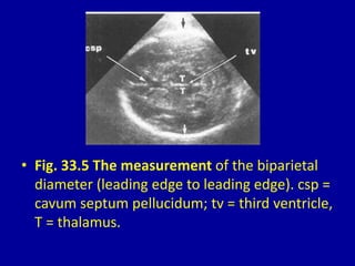 • Fig. 33.5 The measurement of the biparietal
diameter (leading edge to leading edge). csp =
cavum septum pellucidum; tv = third ventricle,
T = thalamus.
 