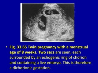 • Fig. 33.65 Twin pregnancy with a menstrual
age of 8 weeks. Two sacs are seen, each
surrounded by an echogenic ring of chorion
and containing a live embryo. This is therefore
a dichorionic gestation.
 