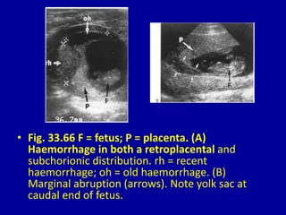 • Fig. 33.66 F = fetus; P = placenta. (A)
Haemorrhage in both a retroplacental and
subchorionic distribution. rh = recent
haemorrhage; oh = old haemorrhage. (B)
Marginal abruption (arrows). Note yolk sac at
caudal end of fetus.
 