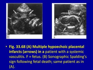 • Fig. 33.68 (A) Multiple hypoechoic placental
infarcts (arrows) in a patient with a systemic
vasculitis. F = fetus. (B) Sonographic Spalding's
sign following fetal death; same patient as in
(A).
 