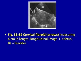 • Fig. 33.69 Cervical fibroid (arrows) measuring
4 cm in length, longitudinal image. F = fetus;
BL = bladder.
 