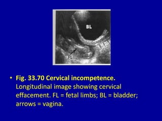 • Fig. 33.70 Cervical incompetence.
Longitudinal image showing cervical
effacement. FL = fetal limbs; BL = bladder;
arrows = vagina.
 