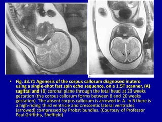 • Fig. 33.71 Agenesis of the corpus callosum diagnosed inutero
using a single-shot fast spin echo sequence, on a 1.5T scanner, (A)
sagittal and (B) coronal plane through the fetal head at 23 weeks
gestation (the corpus callosum forms between 8 and 20 weeks
gestation). The absent corpus callosum is arrowed in A. In B there is
a high-riding third ventricle and crescentic lateral ventricles
(arrowed) compressed by Probst bundles. (Courtesy of Professor
Paul Griffiths, Sheffield)
 