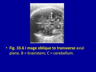 • Fig. 33.6 I mage oblique to transverse axial
plane. B = brainstem; C = cerebellum.
 