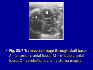• Fig. 33.7 Transverse image through skull base.
A = anterior cranial fossa; M = middle cranial
fossa; C = cerebellum; cm = cisterna magna.
 