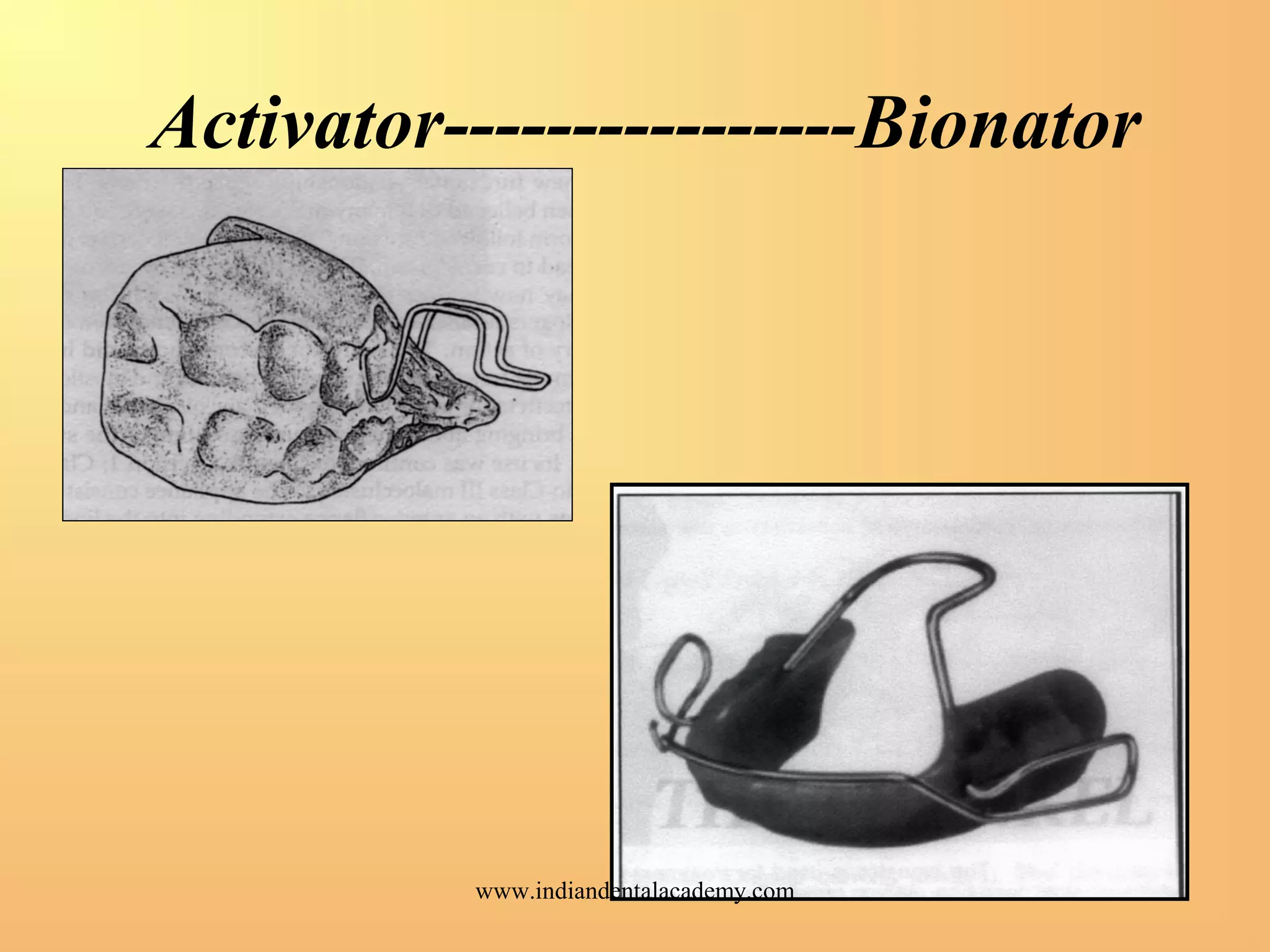 Activator----------------Bionator
www.indiandentalacademy.com
 