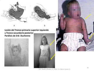 Lesión del Tronco primario superior izquierdo
y Tronco secundario posterior
Parálisis de Erb- Duchenne
24
M.B. Beatriz Rosales G./ Med. Cir. Mario Gámez R.
 
