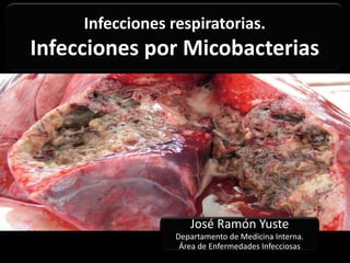 Infecciones respiratorias.
Infecciones por Micobacterias
José Ramón Yuste
Departamento de Medicina Interna.
Área de Enfermedades Infecciosas
 