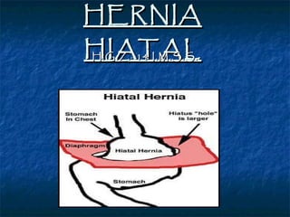 HERNIA HIATAL H.G.Z.· 14 I.M.S.S. 