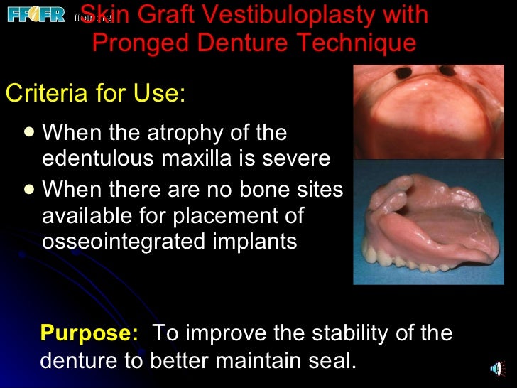 33.reconstructive preprosthetic surgery (n)