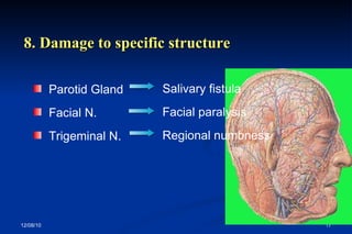 8. Damage to specific structure Parotid Gland Facial N.  Trigeminal N. Salivary fistula Facial paralysis Regional numbness 