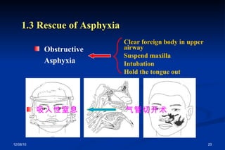 1.3 Rescue of Asphyxia Clear foreign body in upper airway Suspend maxilla Intubation Hold the tongue out Obstructive Asphyxia  吸入性窒息 气管切开术 