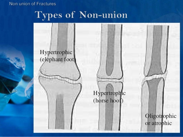 bone-fractures-nonunion-diagnosis-and-management-at-shaheed-suhraward…