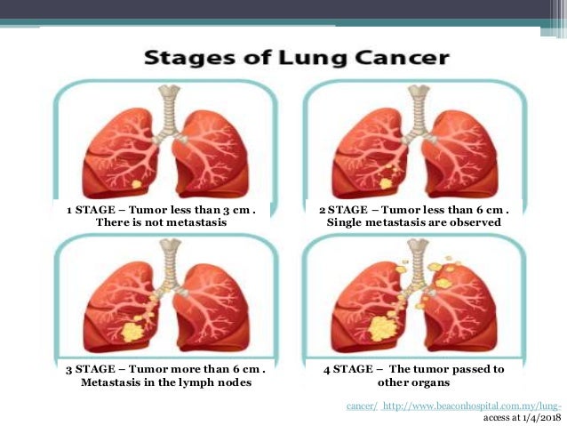 beta-carotene and lung cancer in smokers