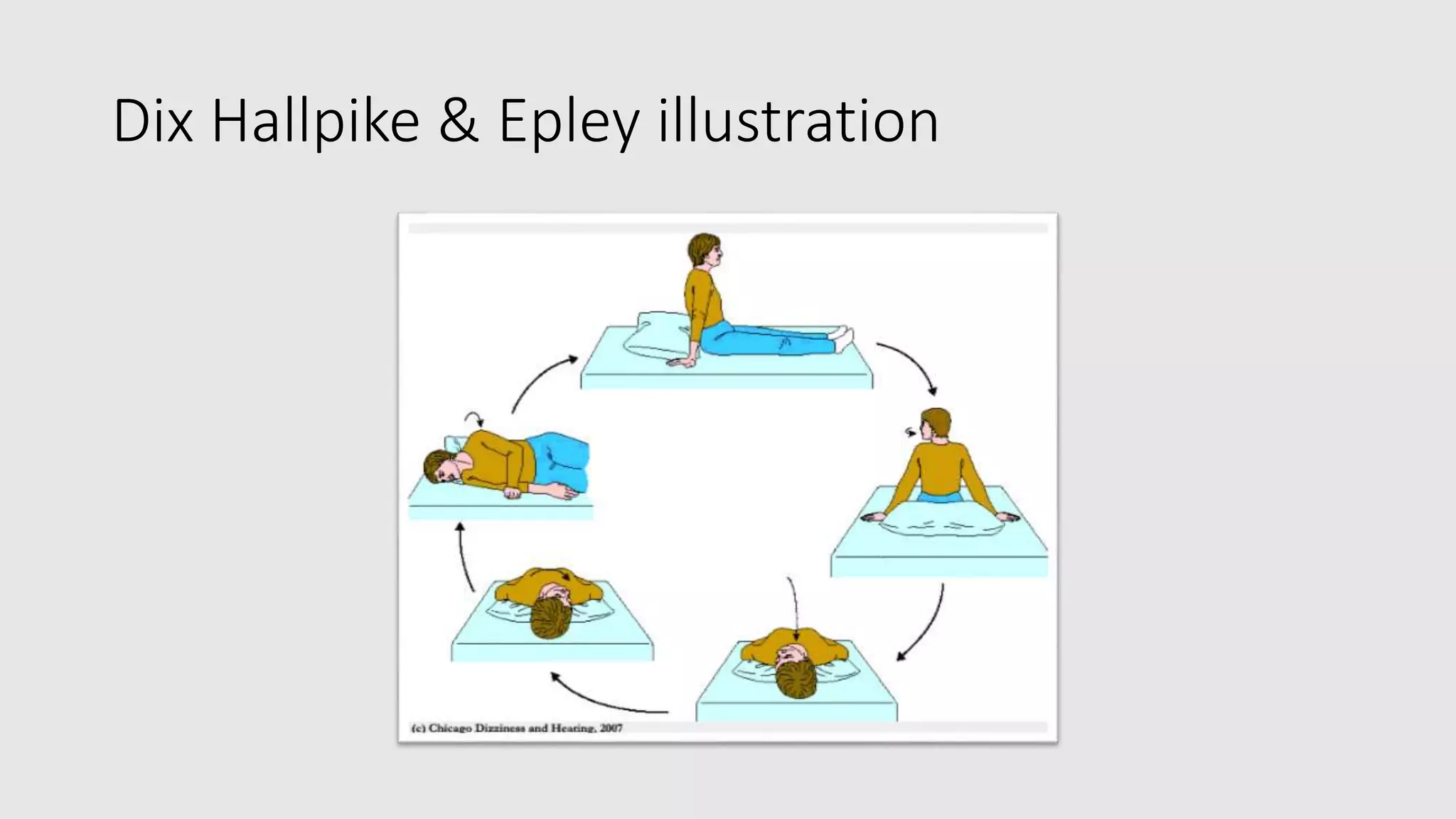 Dix Hallpike & Epley illustration
 