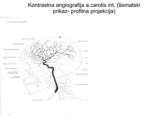 Kontrastna angiografija a.carotis int. (šematski
prikaz- profilna projekcija)
 