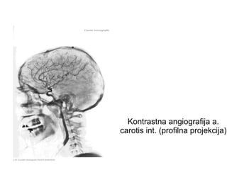 Kontrastna angiografija a.
carotis int. (profilna projekcija)
 