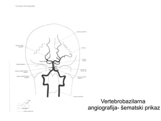 Vertebrobazilarna
angiografija- šematski prikaz
 