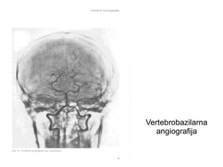 Vertebrobazilarna
angiografija
 