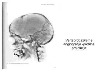 Vertebrobazilarne
angiografija -profilna
projekcija
 