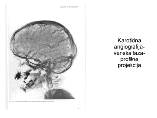 Karotidna
angiografija-
venska faza-
profilna
projekcija
 