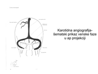 Karotidna angiografija-
šematski prikaz venske faze
u ap projekciji
 