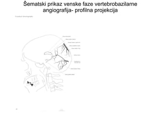Šematski prikaz venske faze vertebrobazilarne
angiografija- profilna projekcija
 