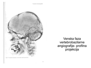 Venska faza
vertebrobazilarne
angiografije- profilna
projekcija
 