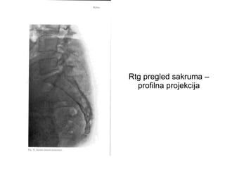 Rtg pregled sakruma –
profilna projekcija
 