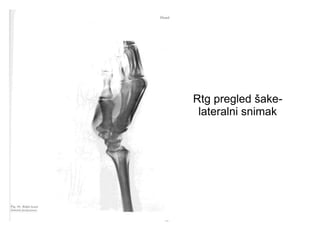 Rtg pregled šake-
lateralni snimak
 