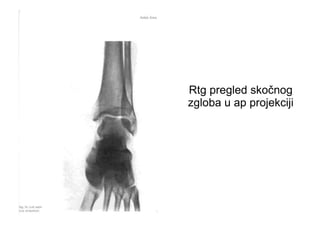 Rtg pregled skočnog
zgloba u ap projekciji
 
